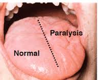 How to Spot Someone Having a Stroke How to Spot Someone Having a Stroke